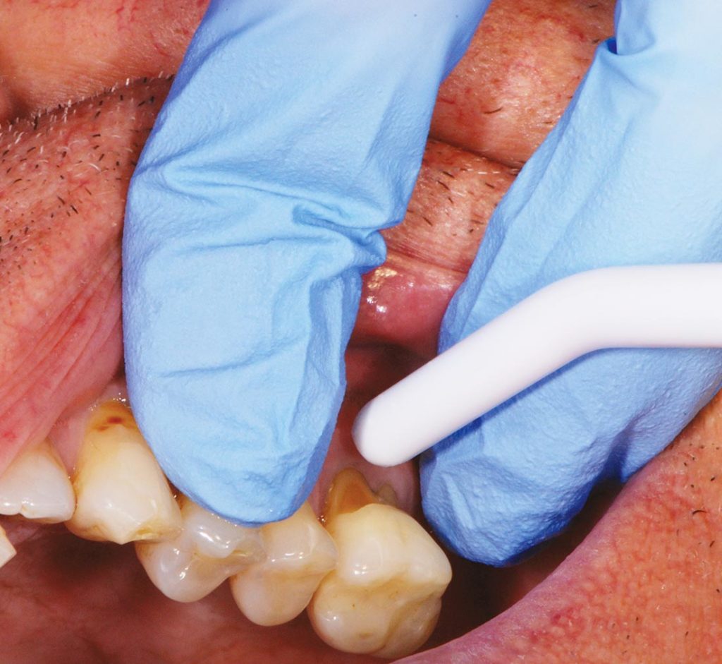 FIG. 1 Valutazione dell'ipersensibilità dentinale tramite Air blast test.